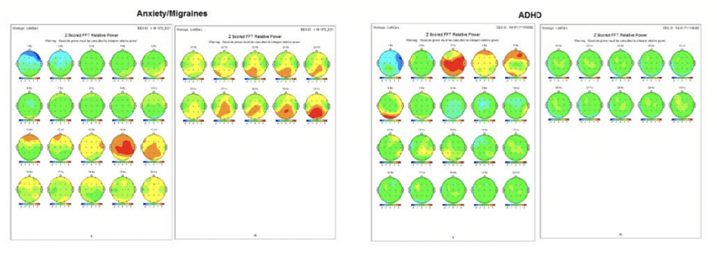 quantitative electroencephalograph assessment